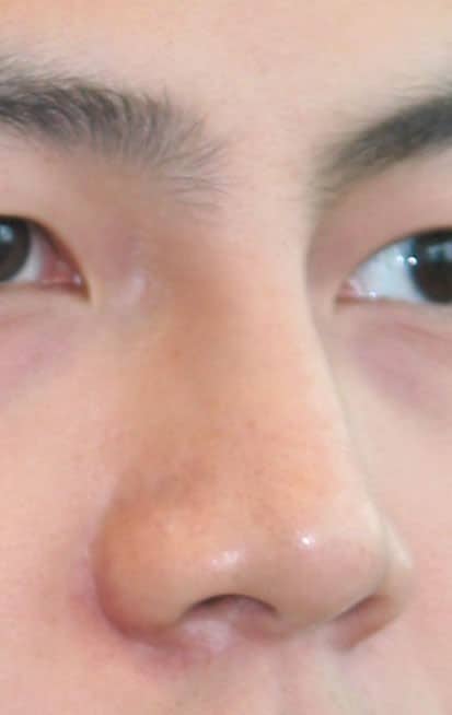 Nose surgery