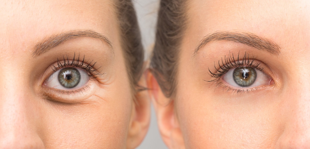 Lower Eye Bag Removal