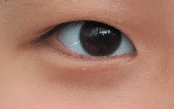 visible epicanthic fold